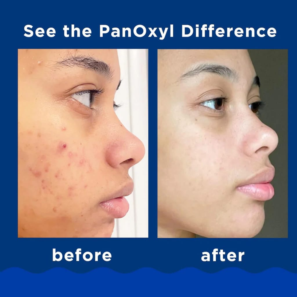 PanOxyl Acne Foaming Wash Benzoyl Peroxide image 2